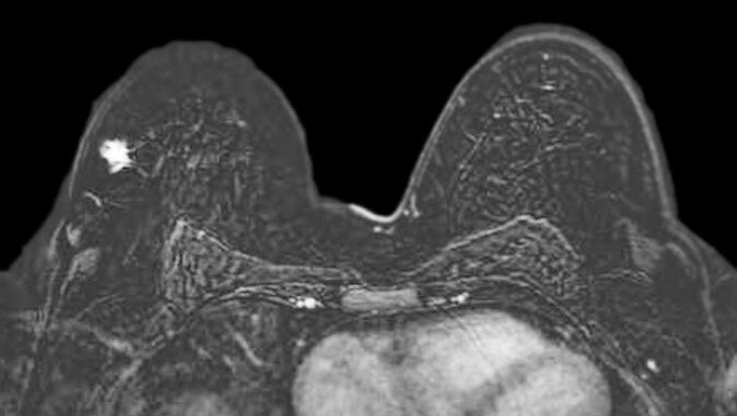 Breast MRI demonstrating breast cancer